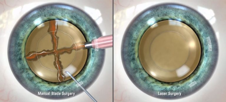 Metal Blade and Laser Cataract Surgery Differences