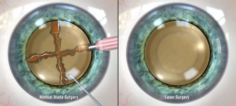 Symptoms of Cataracts