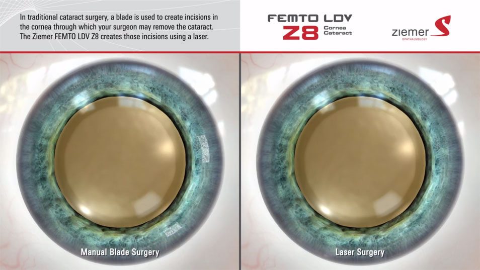 Laser-Assisted Cataract Surgery