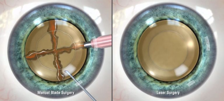 Cataract Surgery