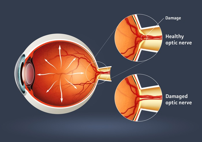 Healthy and Damaged Optic Nerves