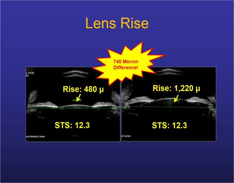 ICL Lens Rise Comparison