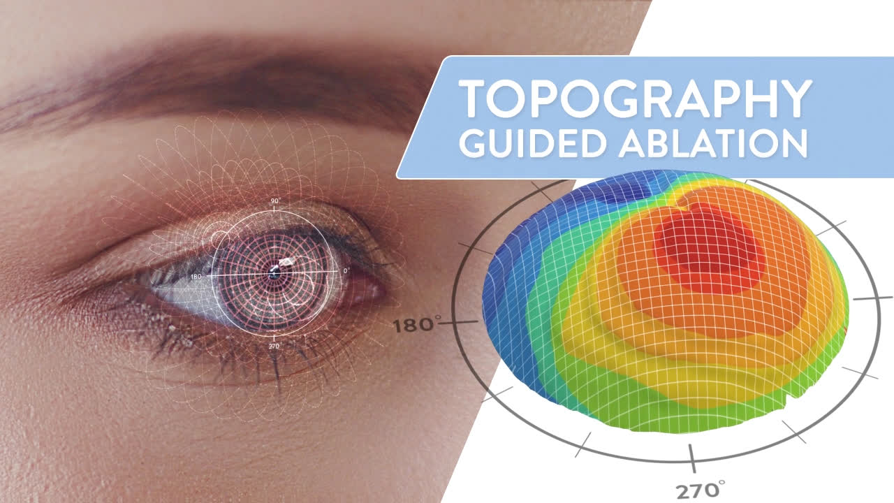 NAR_Topo-LASIK_fullscreen_poster