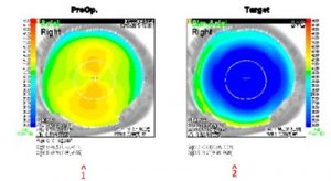 Topography Lasik Data