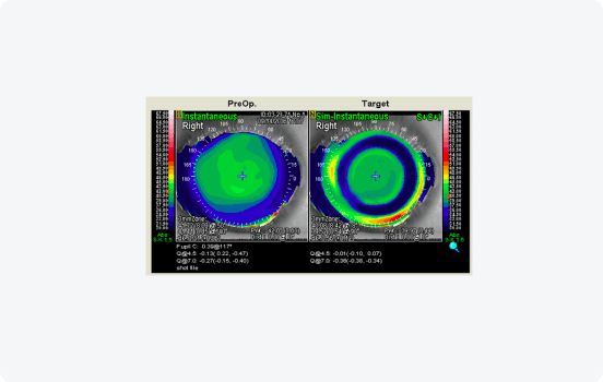 Topography Guided LASIK Catz Data
