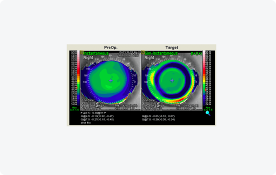 CATz Topography-Assisted LASIK