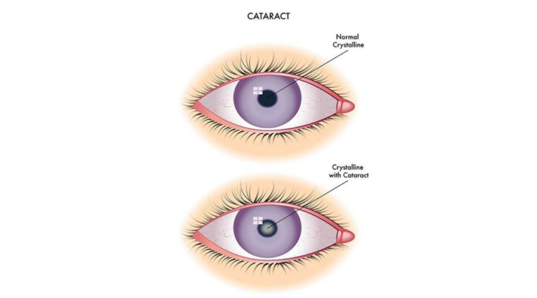 A Complete Explanation Between Traditional and Laser Cataract Surgery