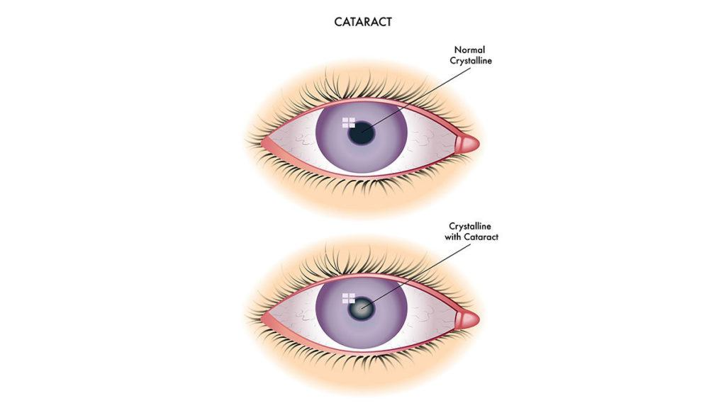A Complete Explanation Between Traditional And Laser Cataract Surgery