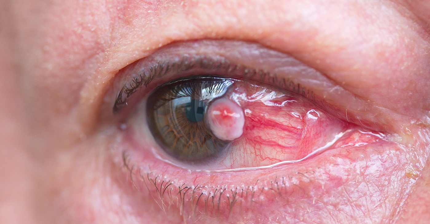 eye-with-pterygium