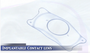 Implantable Contact Lens