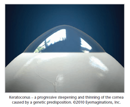 Progressive steepening and thinning of the cornea
