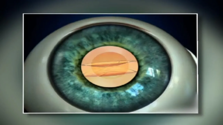 Cataract surgery video