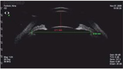 Implantable Contact Lens Measurement