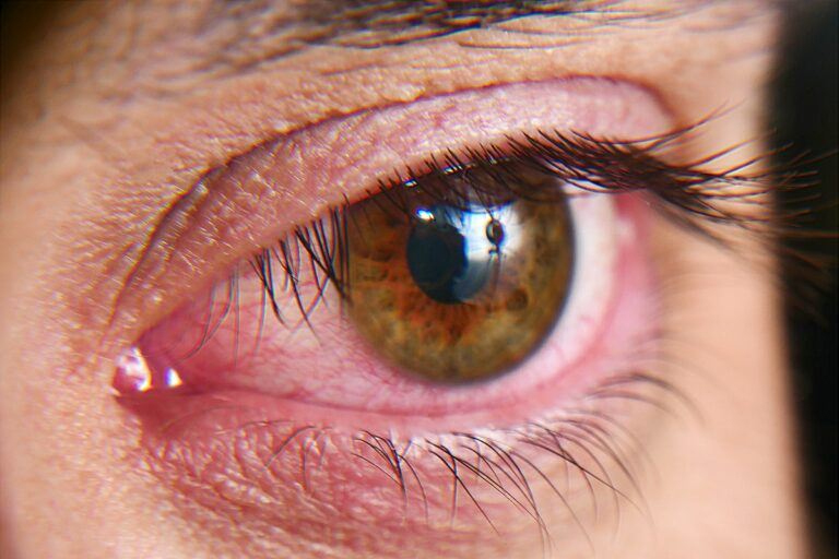 Is Crossing Your Eyes Harmful?