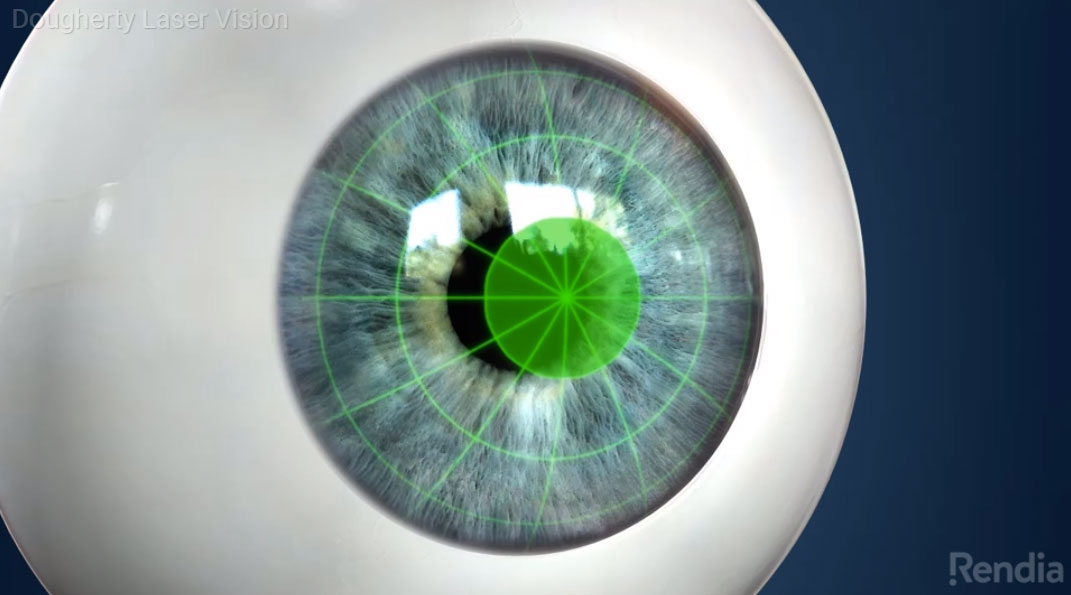 Toric Astigmatism Correcting IOLs