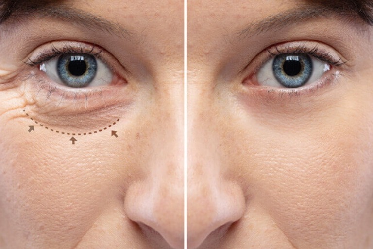 before and after image of blepharoplasty surgery