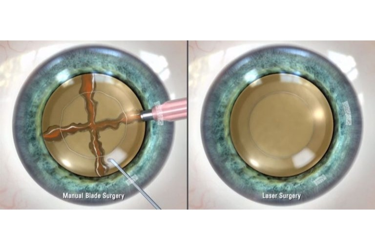 vision cataract surgery