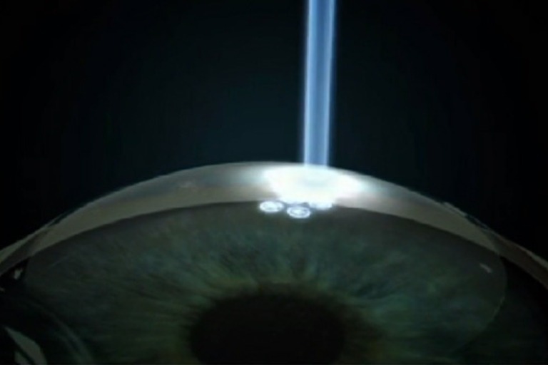 vision lasik surgery
