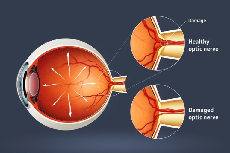 glaucoma treatment illustration