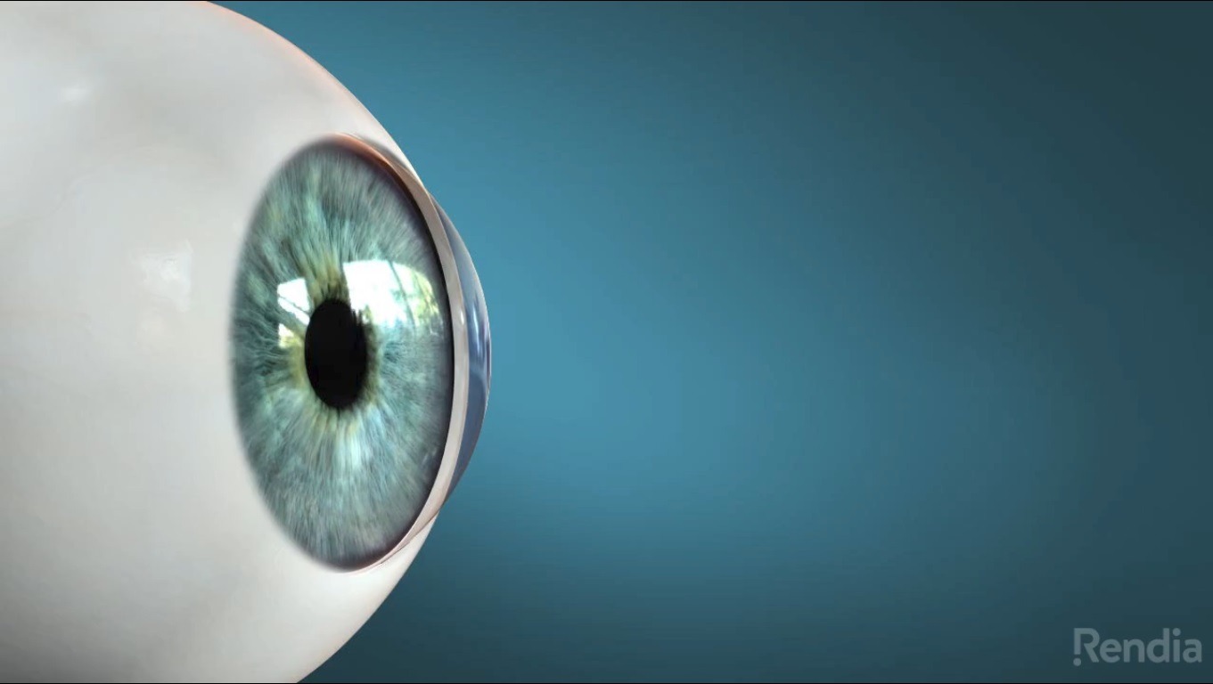Keratoconus video thumbnail keratoconus video thumbnail