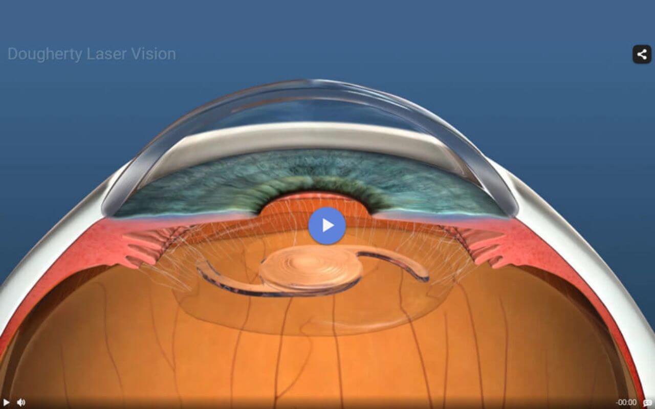 close-up of an eye diagram for lasik at DLV