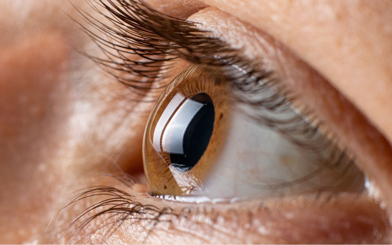close-up of an eye with keratoconus