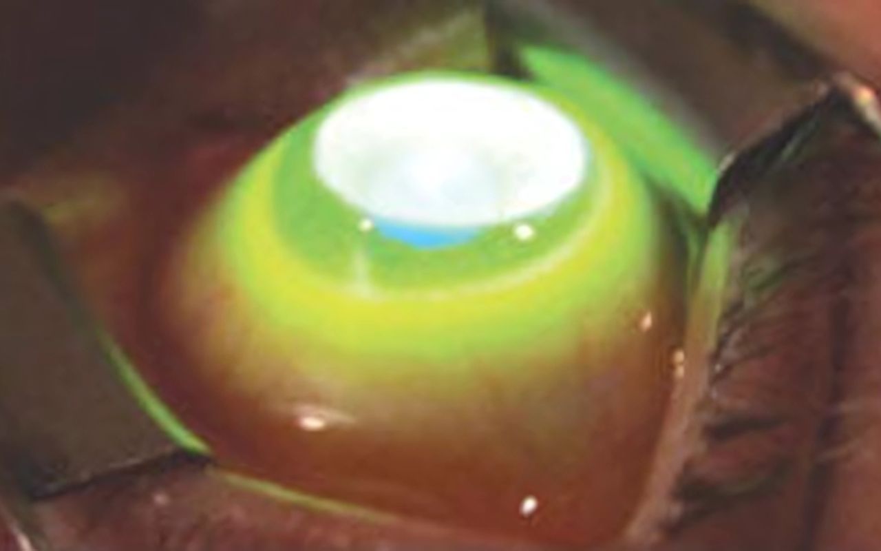 eye surgery at dlv