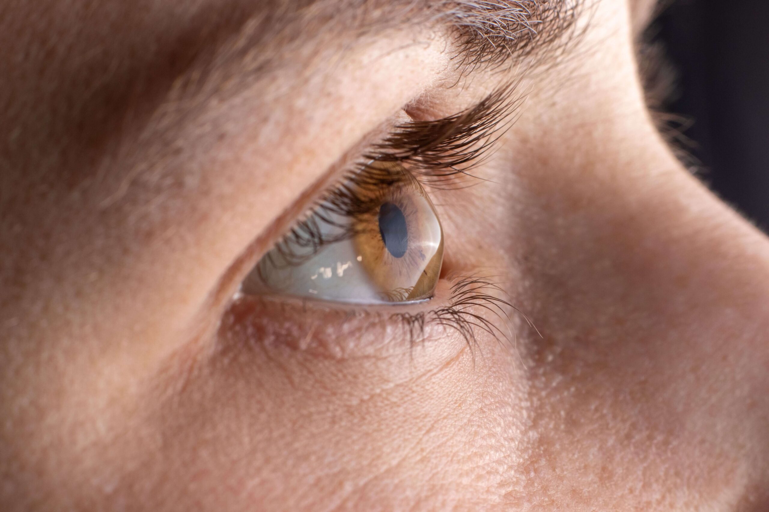 close-up of an eye with keratoconus