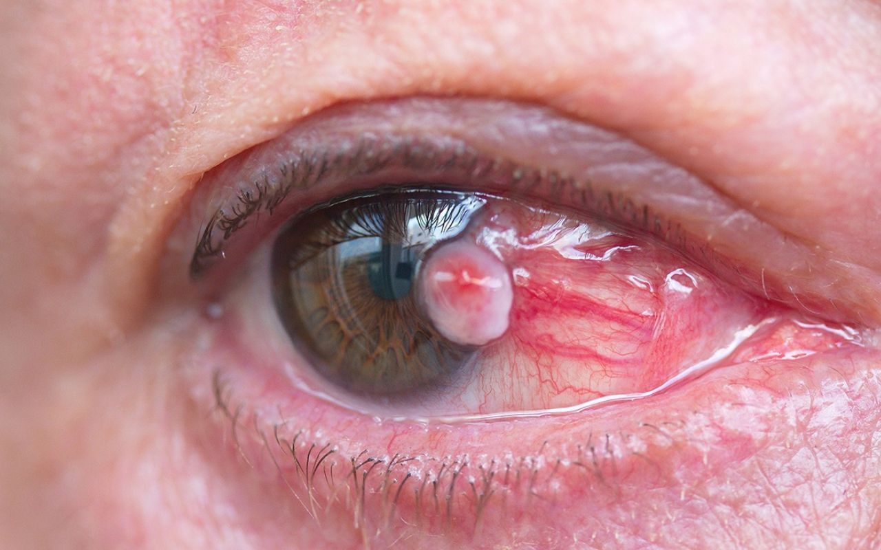 pterygium in the eye