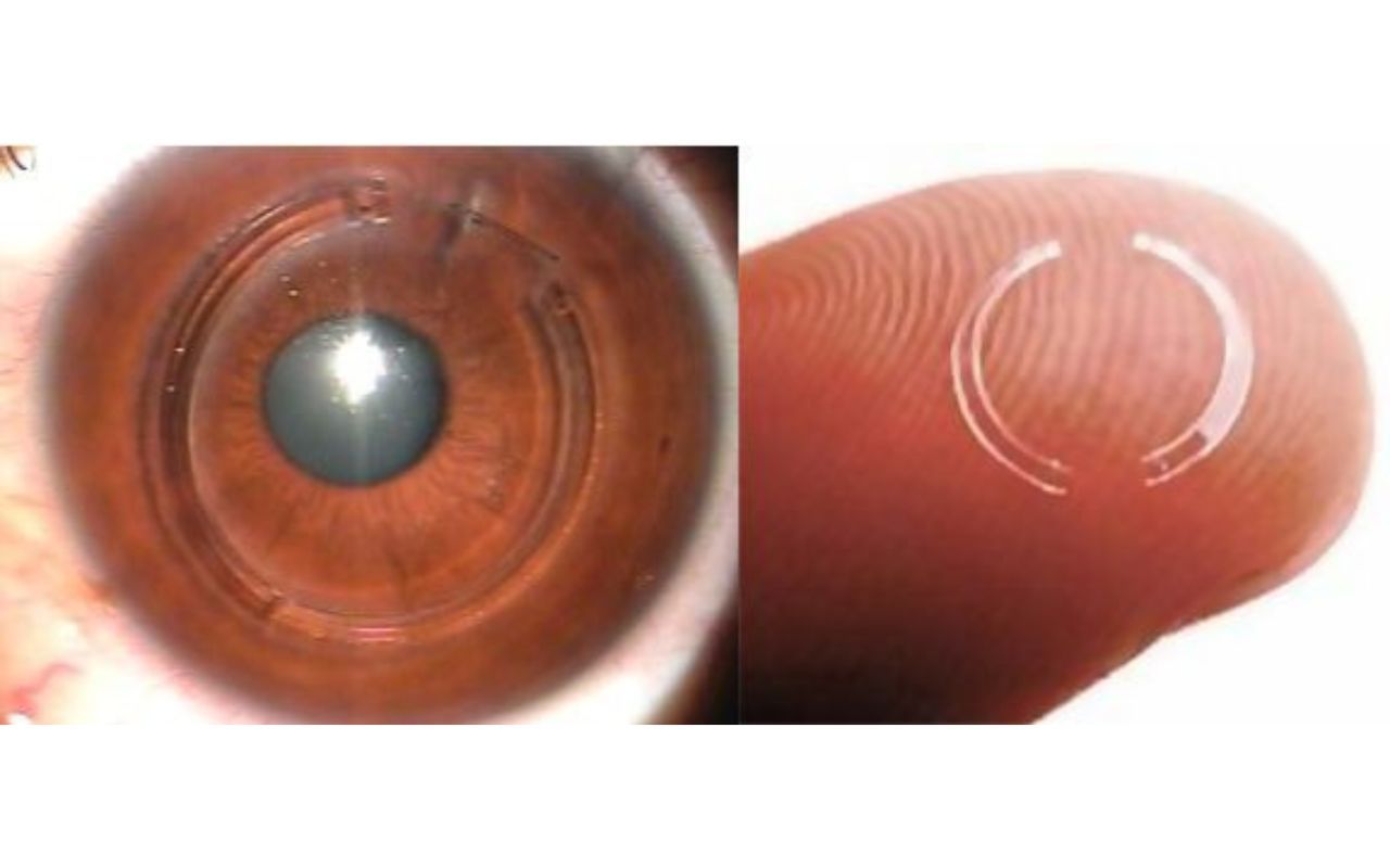 intacs lenses